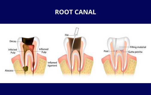 Root Canal Treatment